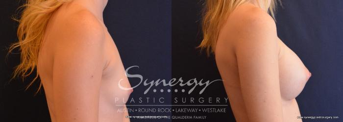 Before & After Breast Augmentation Case 654 View #3 View in Austin, TX