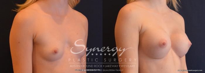 Before & After Breast Augmentation Case 654 View #4 View in Austin, TX