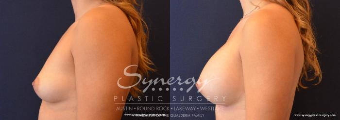 Before & After Breast Augmentation Case 657 View #3 View in Austin, TX