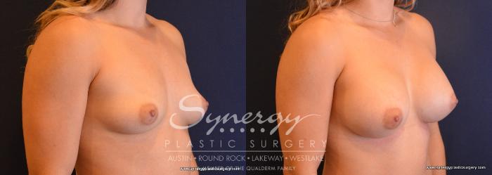 Before & After Breast Augmentation Case 657 View #4 View in Austin, TX