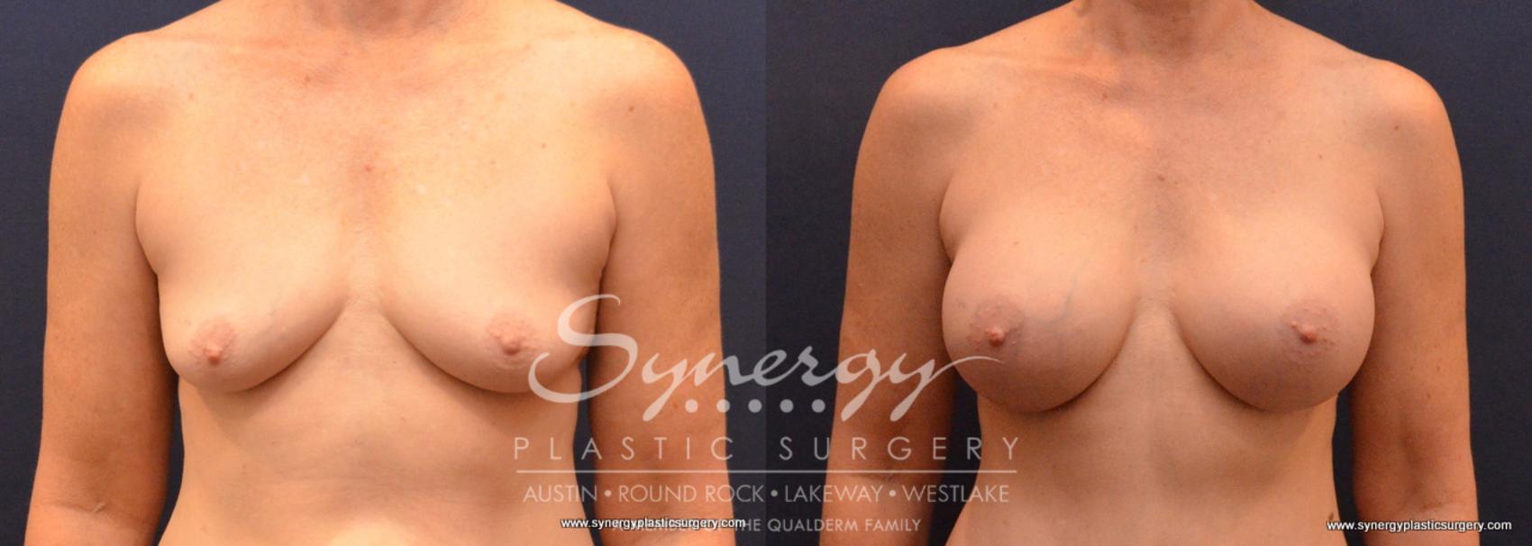 Before & After Breast Augmentation Case 659 View #1 View in Austin, TX