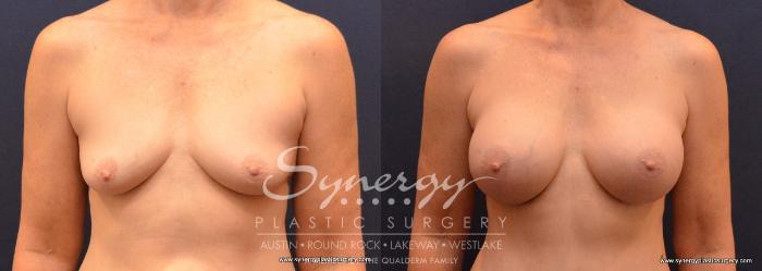 Before & After Breast Augmentation Case 659 View #1 View in Austin, TX