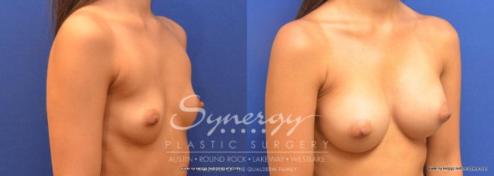 Before & After Breast Augmentation Case 662 View #3 View in Austin, TX