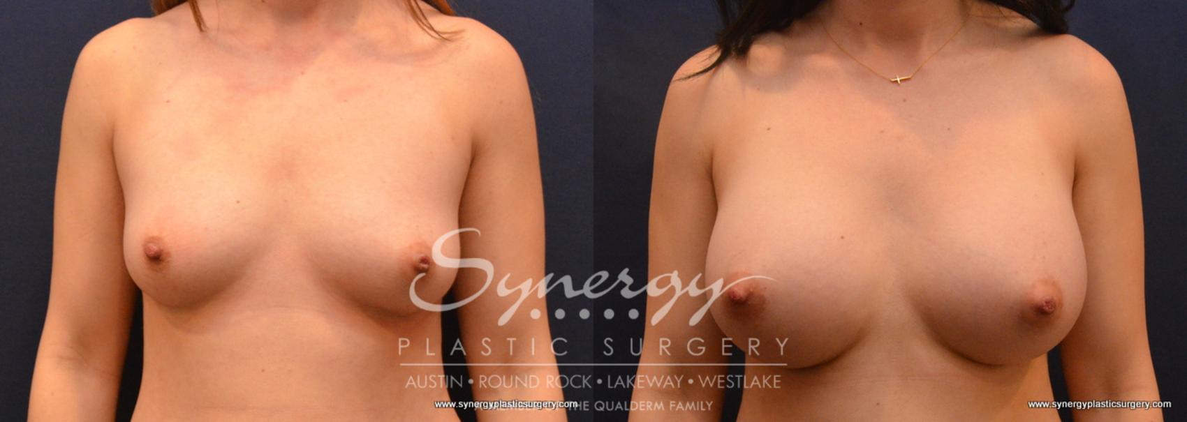 Before & After Breast Augmentation Case 663 View #1 View in Austin, TX
