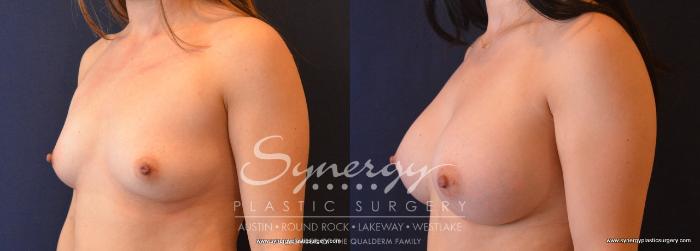 Before & After Breast Augmentation Case 663 View #2 View in Austin, TX