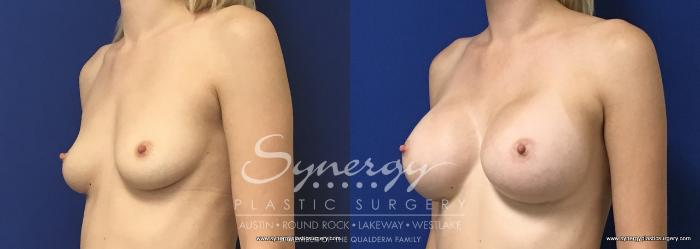 Before & After Breast Augmentation Case 664 View #4 View in Austin, TX
