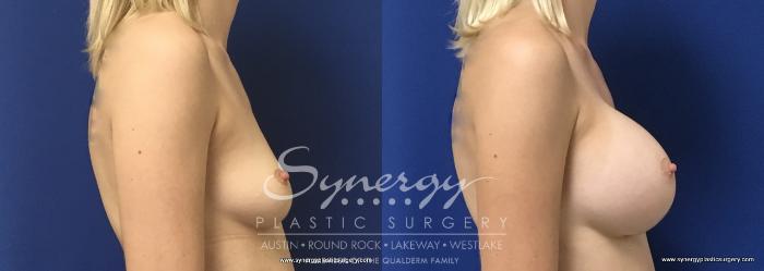 Before & After Breast Augmentation Case 664 View #5 View in Austin, TX