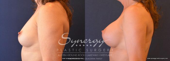 Before & After Breast Augmentation Case 665 View #3 View in Austin, TX
