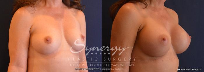 Before & After Breast Augmentation Case 665 View #4 View in Austin, TX