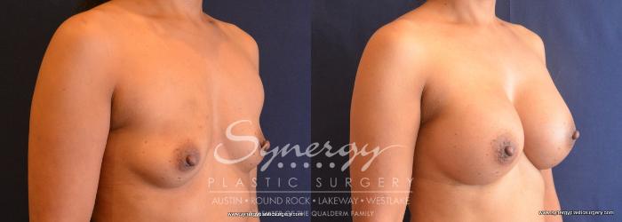 Before & After Breast Augmentation Case 668 View #2 View in Austin, TX