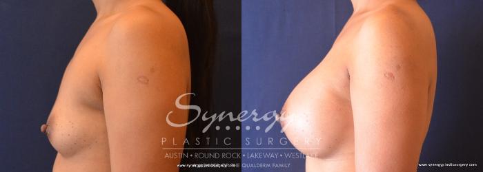 Before & After Breast Augmentation Case 668 View #5 View in Austin, TX