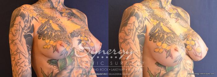 Before & After Breast Augmentation Case 669 View #2 View in Austin, TX