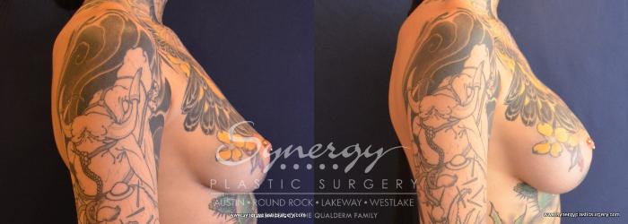 Before & After Breast Augmentation Case 669 View #3 View in Austin, TX