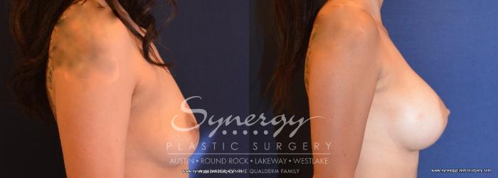 Before & After Breast Augmentation Case 670 View #5 View in Austin, TX