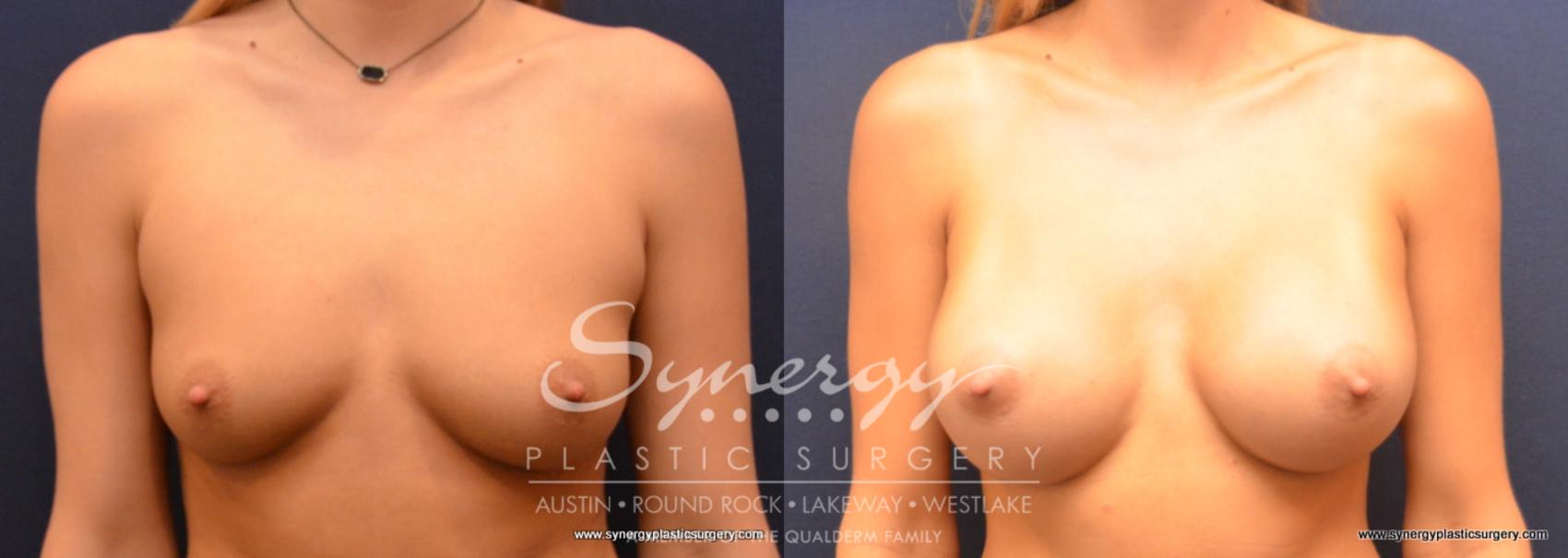 Before & After Breast Augmentation Case 671 View #1 View in Austin, TX