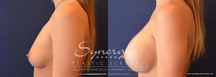 Before & After Breast Augmentation Case 671 View #4 View in Austin, TX
