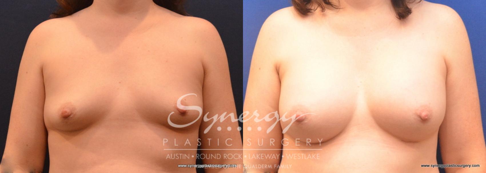 Before & After Breast Augmentation Case 672 View #1 View in Austin, TX