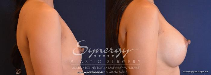 Before & After Breast Augmentation Case 675 View #5 View in Austin, TX