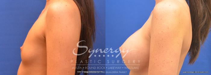 Before & After Breast Augmentation Case 677 View #2 View in Austin, TX
