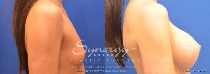 Before & After Breast Augmentation Case 677 View #3 View in Austin, TX