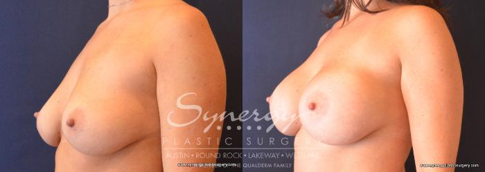 Before & After Breast Augmentation Case 681 View #2 View in Austin, TX