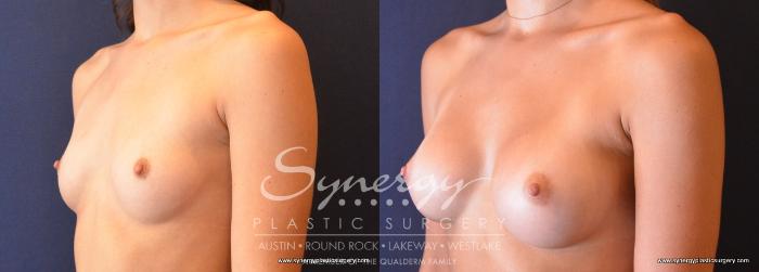 Before & After  Case 684 View #2 View in Austin, TX