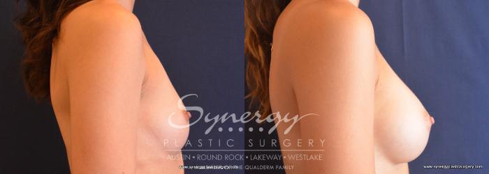 Before & After  Case 684 View #3 View in Austin, TX