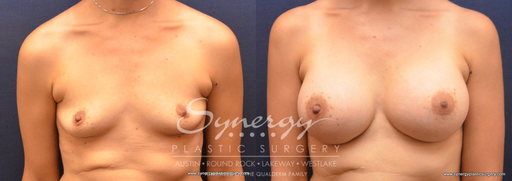Before & After Breast Augmentation Case 685 View #1 View in Austin, TX