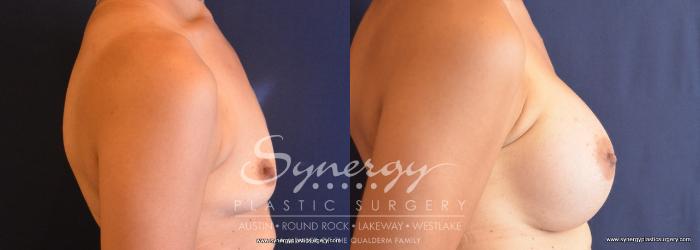 Before & After Breast Augmentation Case 685 View #3 View in Austin, TX