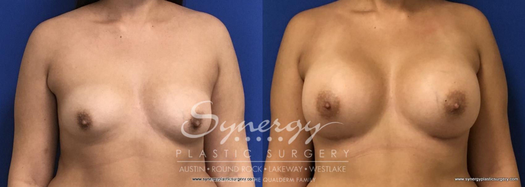Before & After Breast Augmentation Case 686 View #1 View in Austin, TX