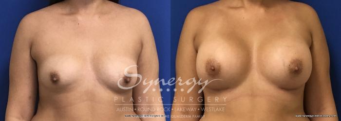 Before & After Breast Augmentation Case 686 View #1 View in Austin, TX