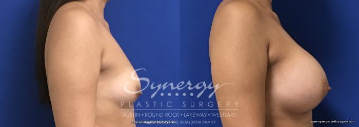 Before & After Breast Augmentation Case 686 View #3 View in Austin, TX
