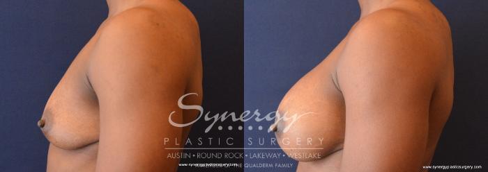 Before & After Breast Augmentation Case 689 View #3 View in Austin, TX