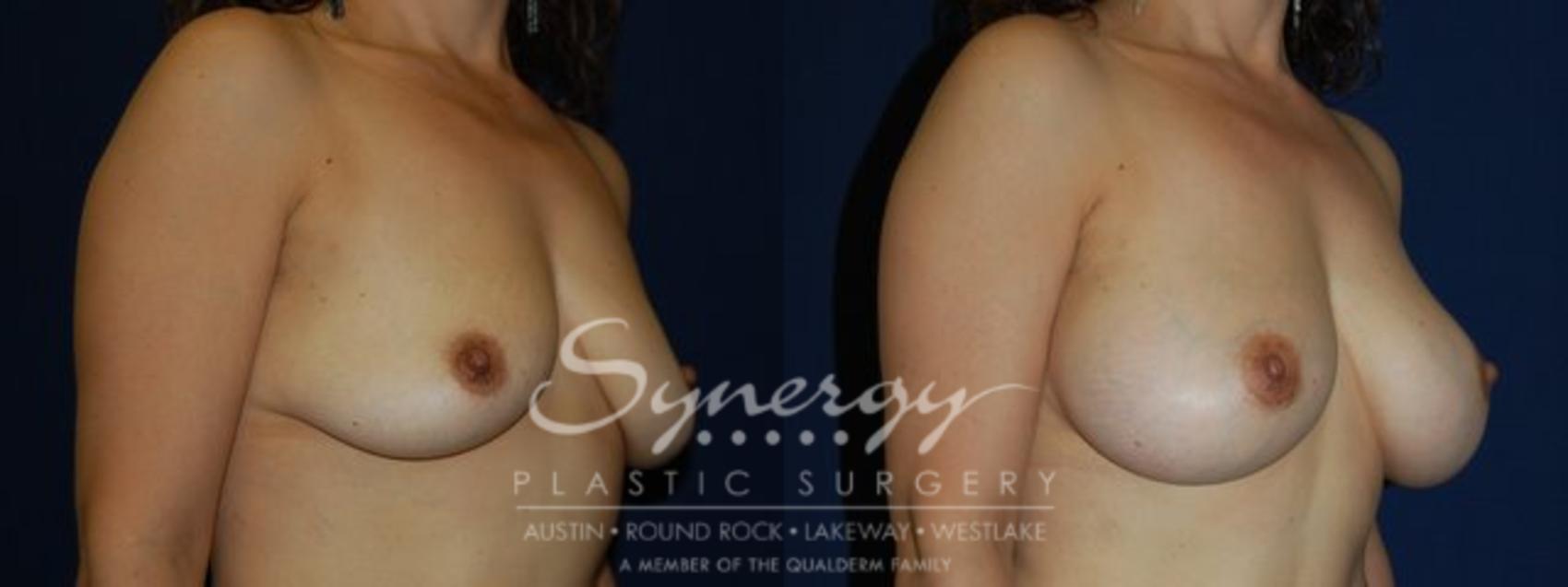 Before & After Breast Augmentation Case 69 View #1 View in Austin, TX