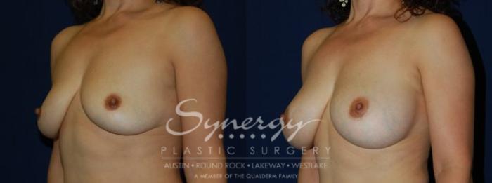 Before & After Breast Augmentation Case 69 View #4 View in Austin, TX