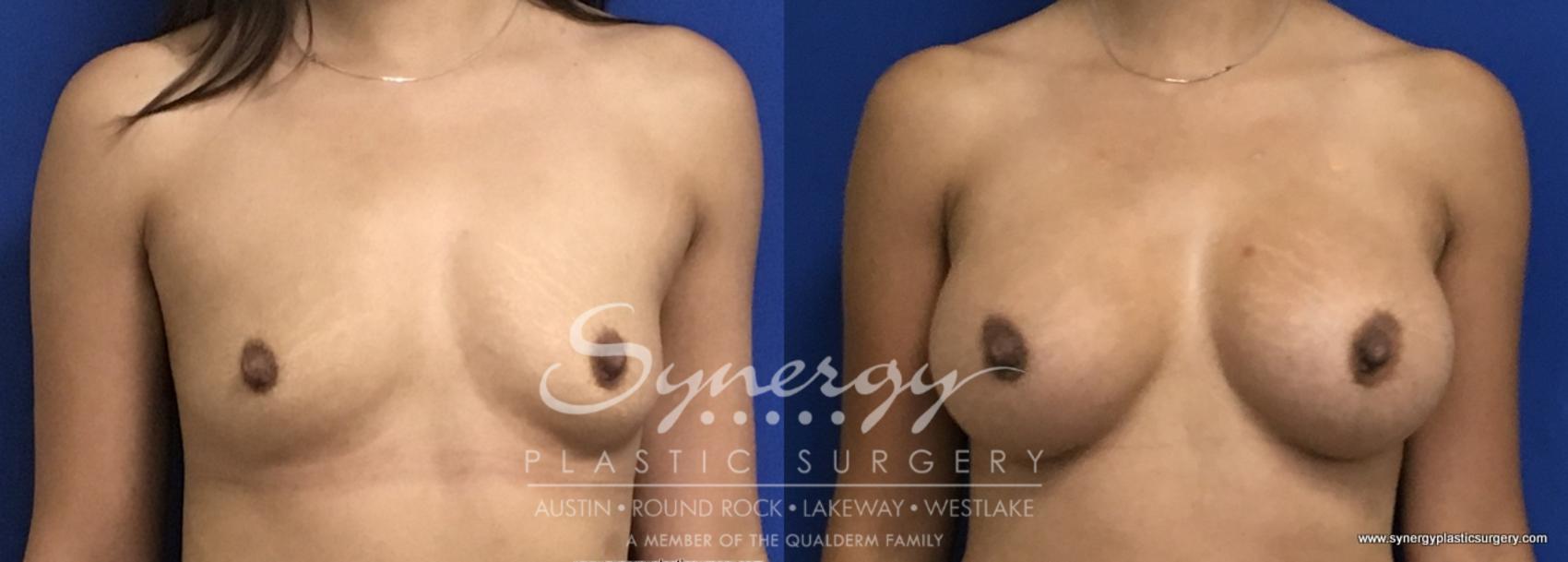 Before & After Breast Augmentation Case 695 View #1 View in Austin, TX
