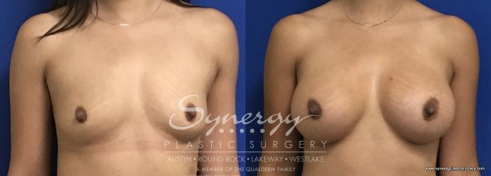 Before & After Breast Augmentation Case 695 View #1 View in Austin, TX