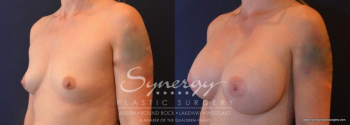 Before & After Breast Augmentation Case 696 View #2 View in Austin, TX