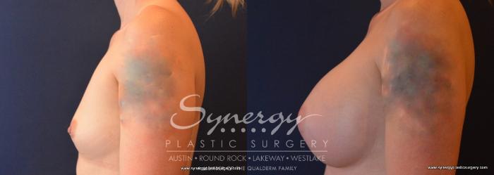 Before & After Breast Augmentation Case 696 View #3 View in Austin, TX