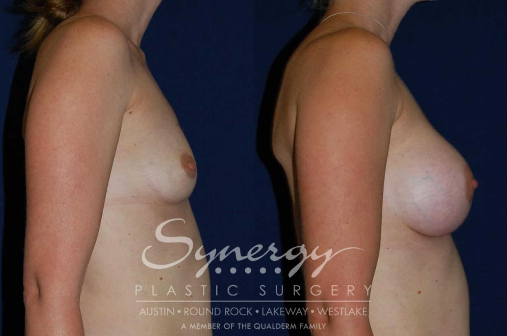 Before & After Breast Augmentation Case 70 View #1 View in Austin, TX