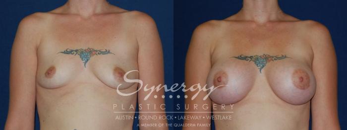Before & After Breast Augmentation Case 70 View #3 View in Austin, TX