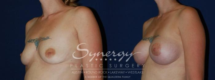Before & After Breast Augmentation Case 70 View #4 View in Austin, TX