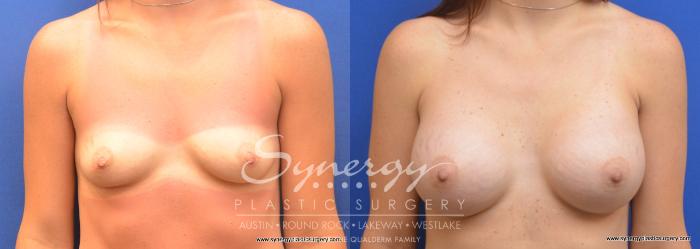 Before & After Breast Augmentation Case 700 View #1 View in Austin, TX