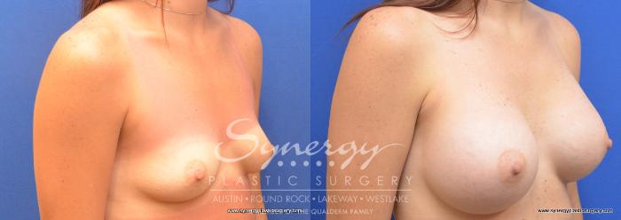 Before & After Breast Augmentation Case 700 View #2 View in Austin, TX