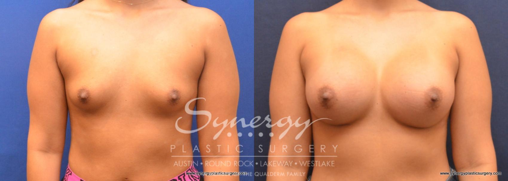 Before & After Breast Augmentation Case 705 View #1 View in Austin, TX