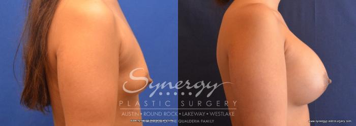 Before & After Breast Augmentation Case 705 View #5 View in Austin, TX