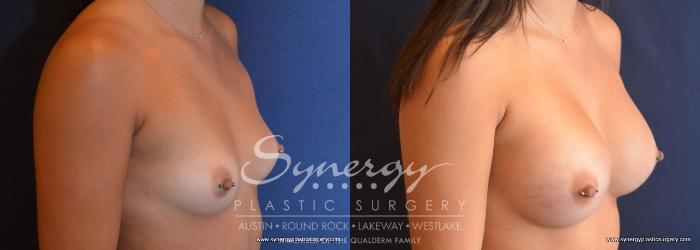 Before & After Breast Augmentation Case 711 View #2 View in Austin, TX