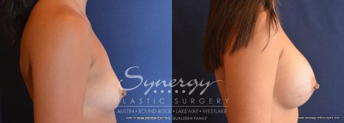 Before & After Breast Augmentation Case 711 View #3 View in Austin, TX