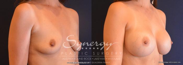 Before & After Breast Augmentation Case 720 View #4 View in Austin, TX