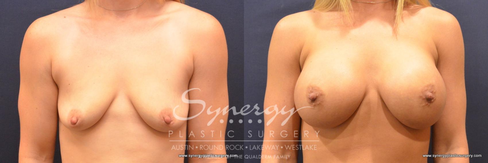 Before & After Breast Augmentation Case 725 View #1 View in Austin, TX